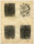 Primary view of [Four Photographs of M. J.'s Sickle-Cell Anemia from Six Hours to Forty-Eight Hours]